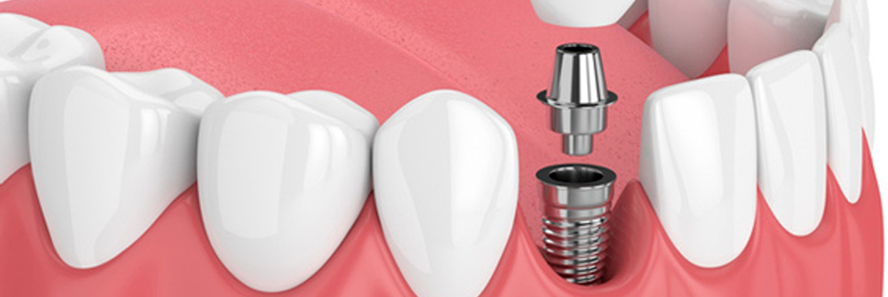 Dental Implants Best Hospital in Rajapalayam